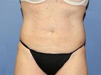 Coolsculpting Before & After