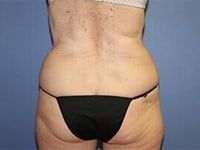 Coolsculpting Before & After