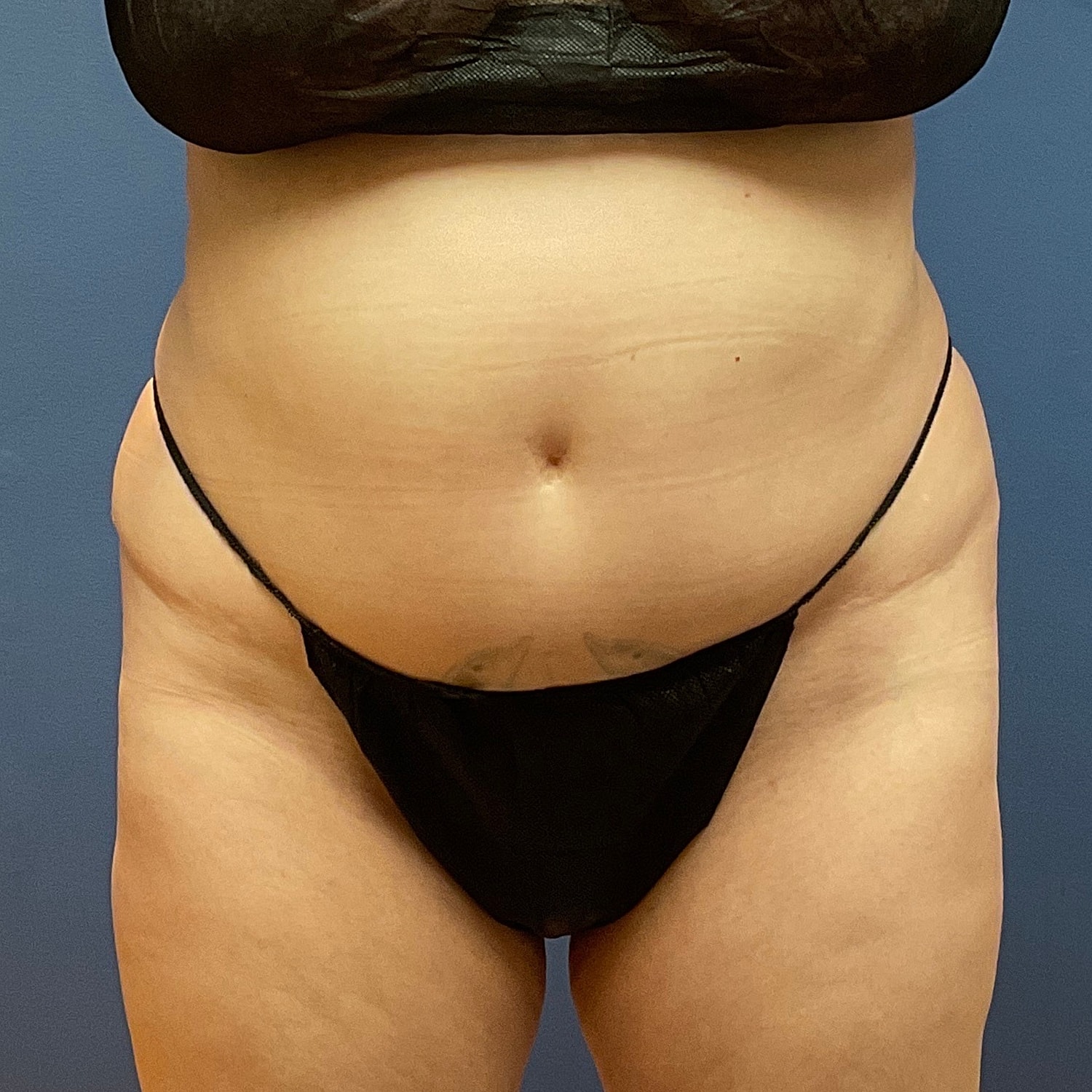 Medical Weight Loss Gallery Before & After