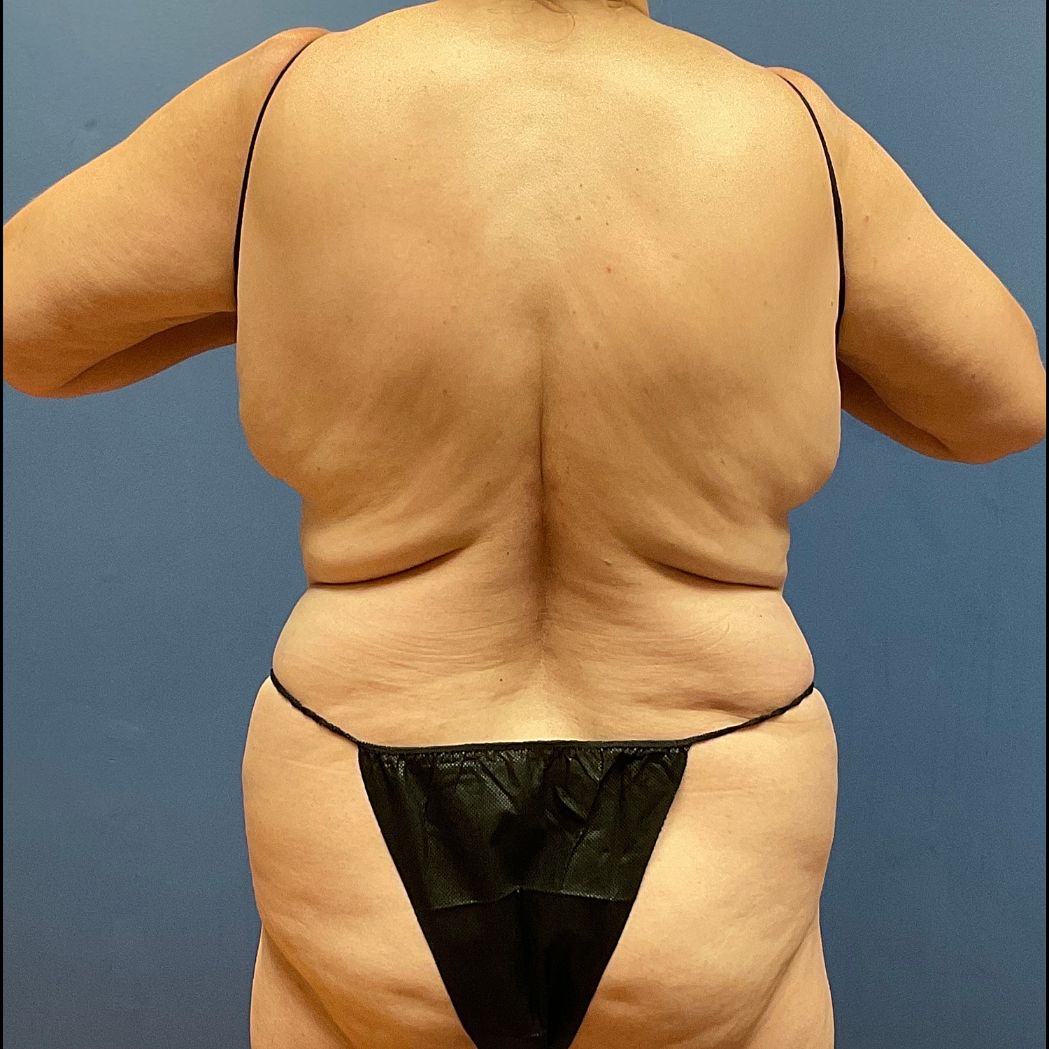 Medical Weight Loss Gallery Before & After