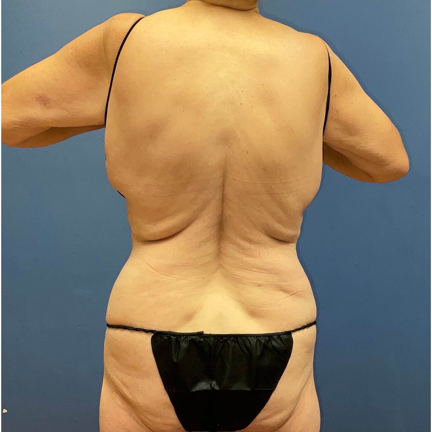 Medical Weight Loss Gallery Before & After