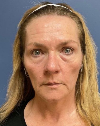 Hydrafacial Before & After