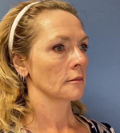 Hydrafacial Before & After