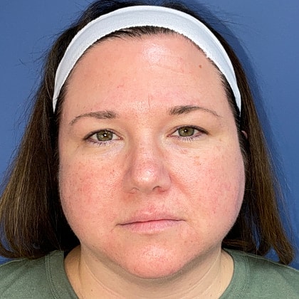 Bbl Hero Before & After