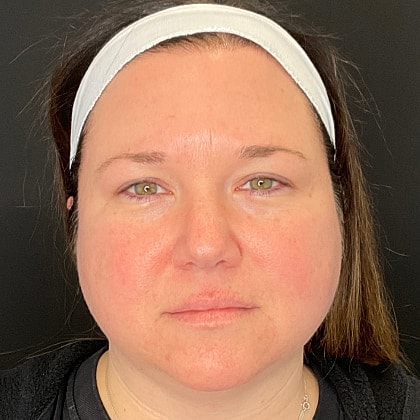 Bbl Hero Before & After