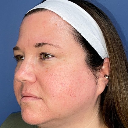 Bbl Hero Before & After