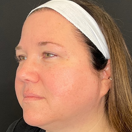 Bbl Hero Before & After