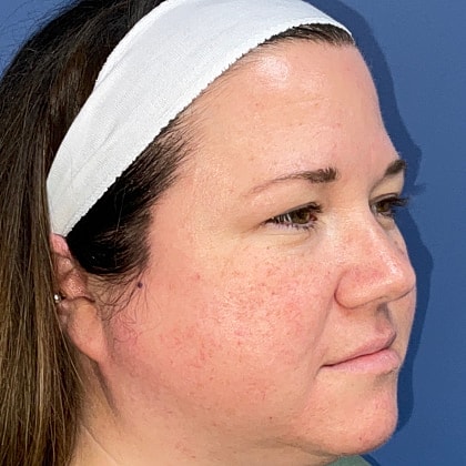 Bbl Hero Before & After