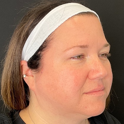 Bbl Hero Before & After