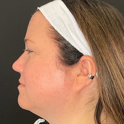 Bbl Hero Before & After