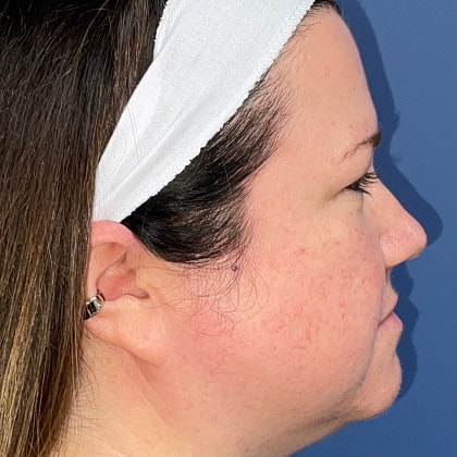 Bbl Hero Before & After