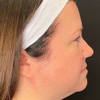 Bbl Hero Before & After