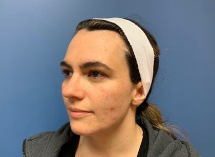 Bbl Hero Before & After