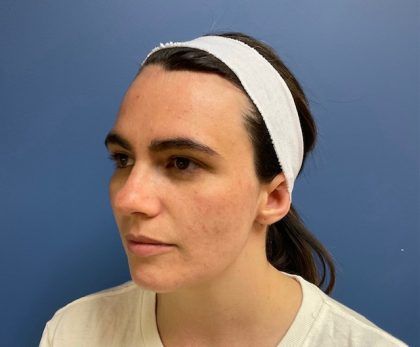 Bbl Hero Before & After