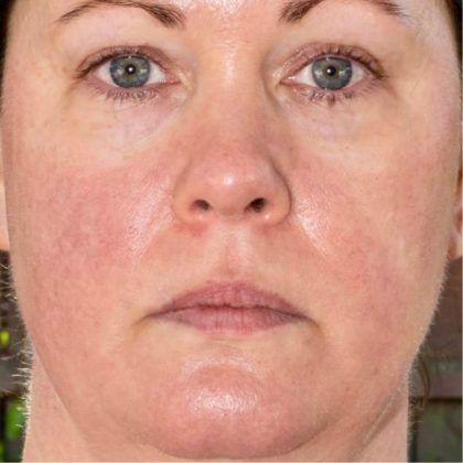 Bbl Hero Before & After