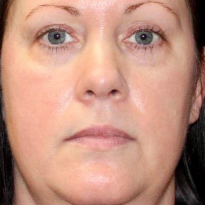 Bbl Hero Before & After