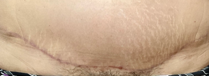 Bbl Hero Before & After