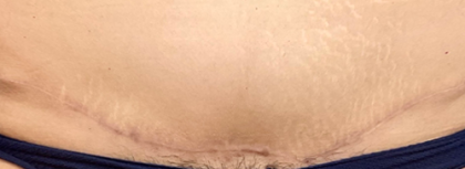 Bbl Hero Before & After