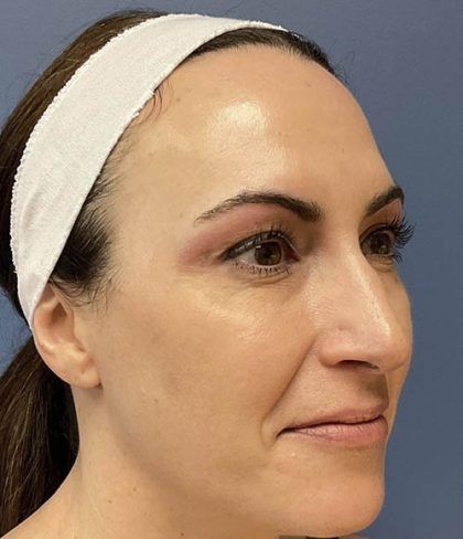 Bbl Hero Before & After