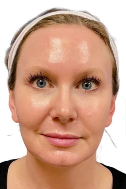 Bbl Hero Before & After