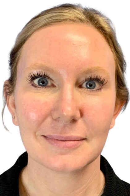 Bbl Hero Before & After