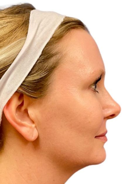 Bbl Hero Before & After