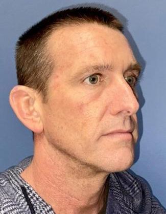 Bbl Hero Before & After