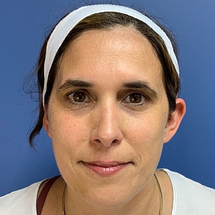 Bbl Hero Before & After