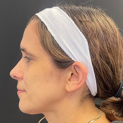 Bbl Hero Before & After