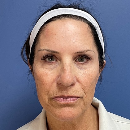 Bbl Hero Before & After