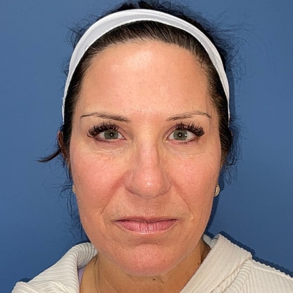 Bbl Hero Before & After