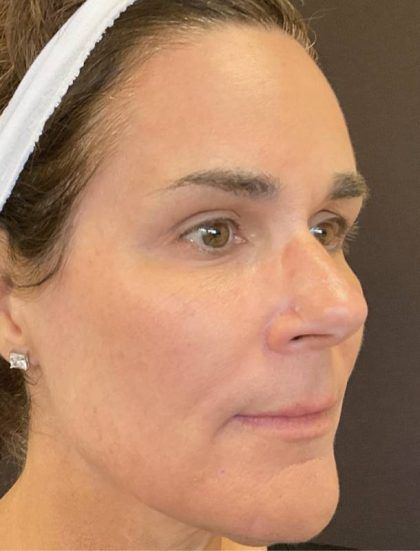 Fraxel Before & After