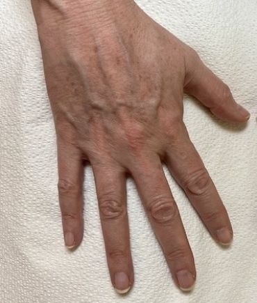 Fraxel Before & After