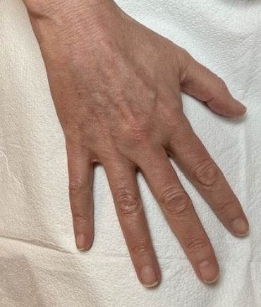 Fraxel Before & After