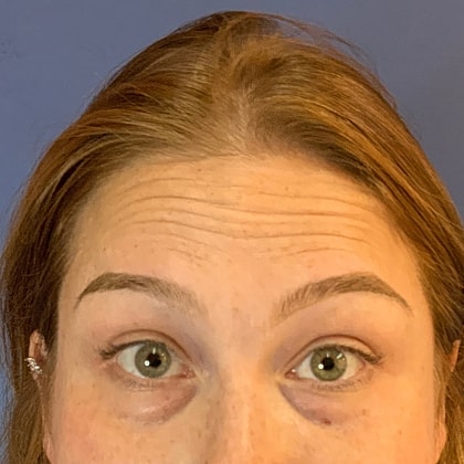 Dysport Before & After