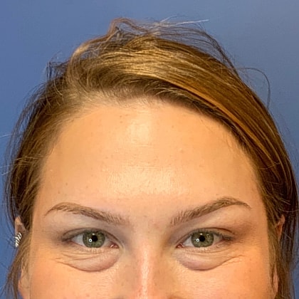 Dysport Before & After