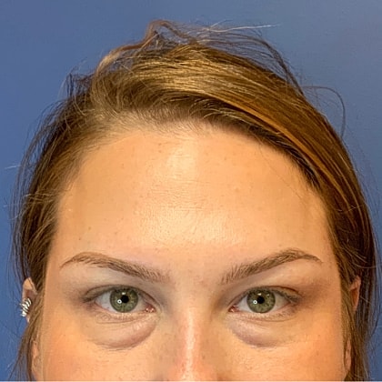 Dysport Before & After