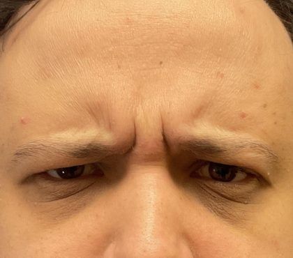 Dysport Before & After