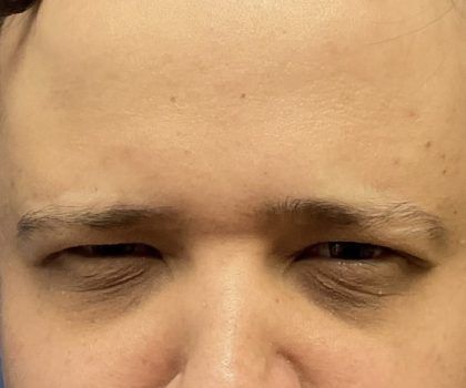 Dysport Before & After