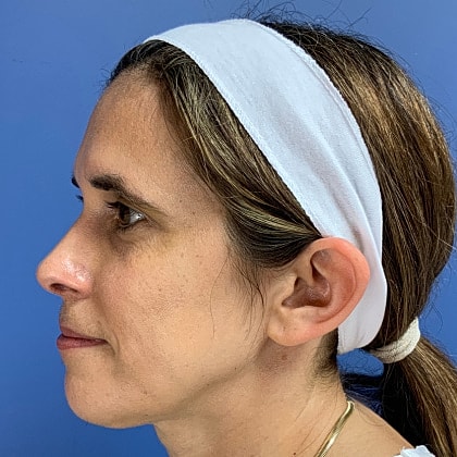 Dysport Before & After