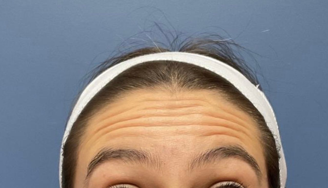 Dysport Before & After