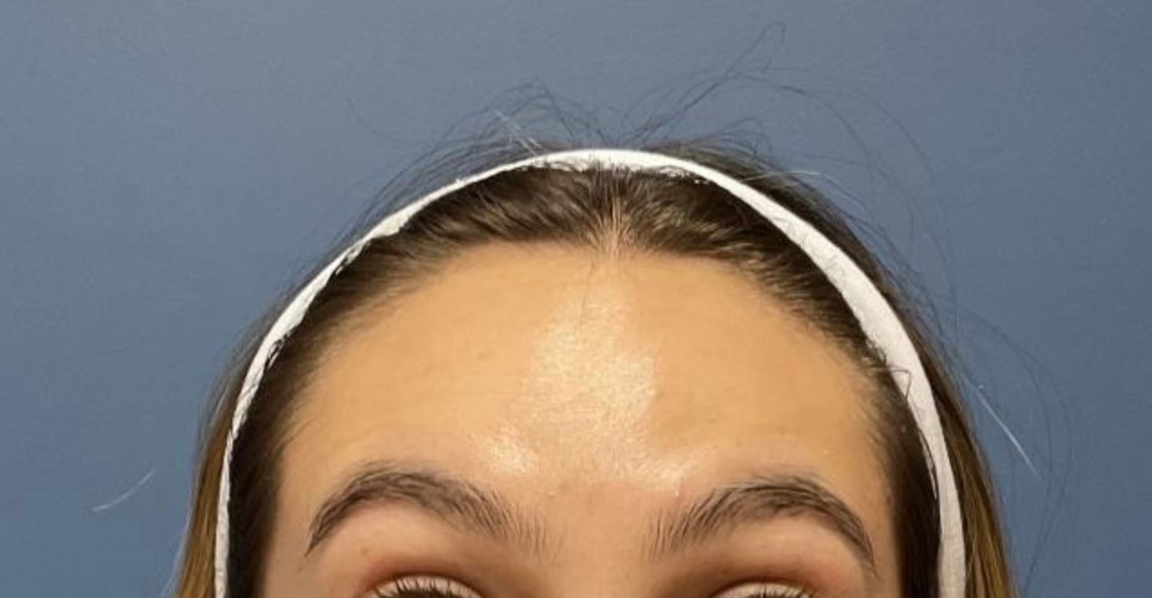 Dysport Before & After