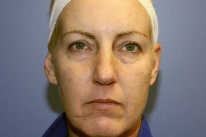 Microneedling Before & After