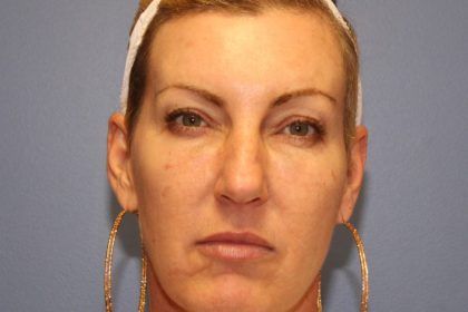 Microneedling Before & After