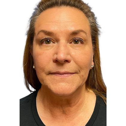 Microneedling Before & After