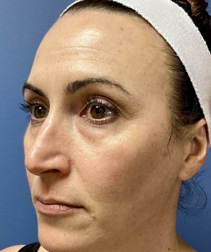 Microneedling Before & After