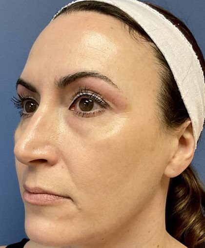 Microneedling Before & After