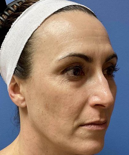 Microneedling Before & After