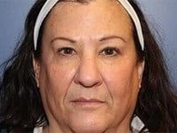 Chemical Peels Before & After