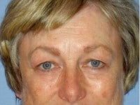 Laser Skin Resurfacing Before & After